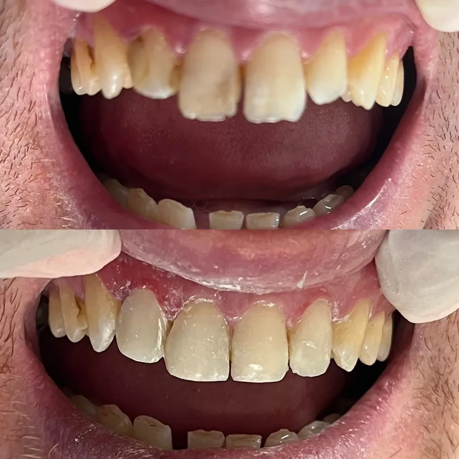 Caso real: sonrisa antes y después del tratamiento