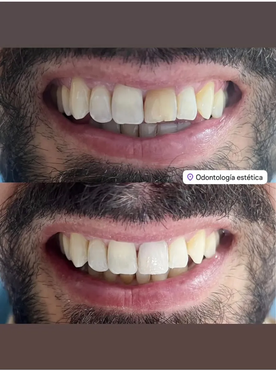 Caso real: sonrisa antes y después del tratamiento